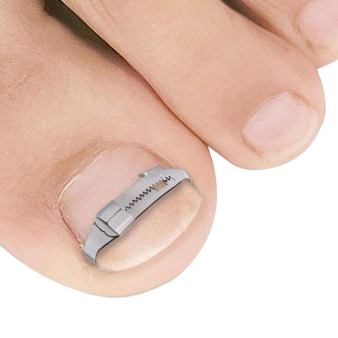 Nail Clip for Ingrown Toenails eStore